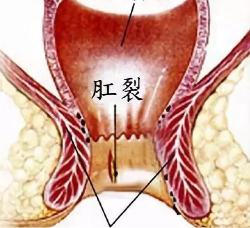 大理肛泰肛肠医院：肛裂长期不愈，当心“哨兵痔”来袭