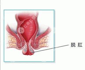 大理肛泰肛肠医院：哪些人群容易患直肠脱垂呢？