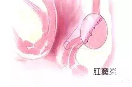 大理肛泰肛肠医院：肛窦炎别等严重了才发现危害！