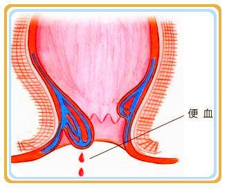 大理肛泰肛肠医院：便血是什么疾病？
