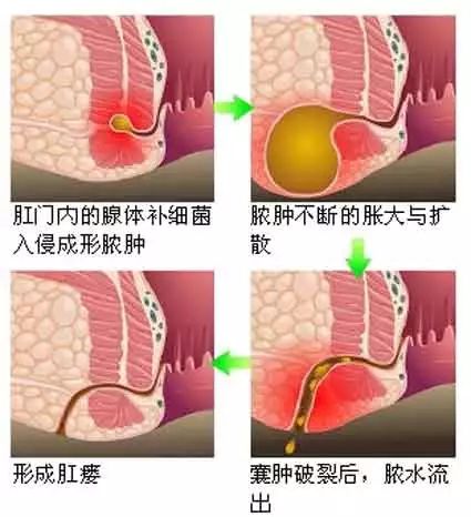 大理肛泰肛肠医院：得了肛瘘怎么办？
