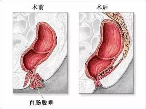 大理肛泰肛肠医院：脱肛到底“脱”的是什么?