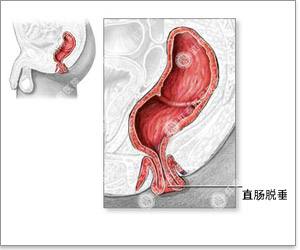 大理肛泰肛肠医院：拉屎拉出“脱肛”