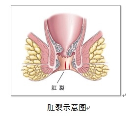 大理肛泰肛肠医院：犯肛裂时,怎么做？