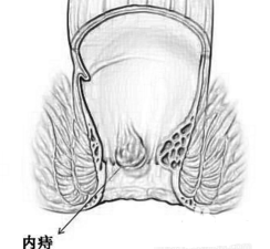 大理肛泰肛肠医院：什么叫内痔？