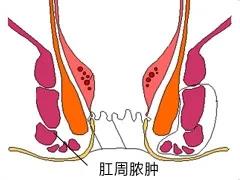 大理肛泰肛肠医院：肛周脓肿有哪些症状?