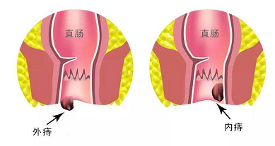 大理肛泰肛肠医院：如何预防内痔？