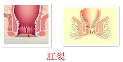 大理肛泰肛肠医院：肛裂是怎么来的？
