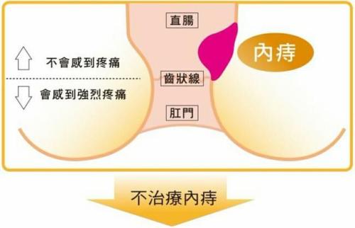 大理肛泰肛肠医院：内痔要怎么治疗？