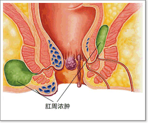 肛周脓肿
