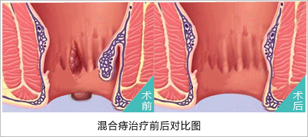 肛肠小知识（三）混合痔百科