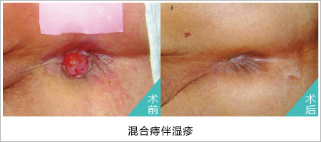 肛肠小知识（三）混合痔百科
