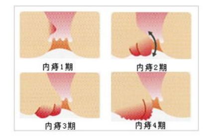 大理肛泰肛肠医院：内痔做这些运动会加快内痔的恢复
