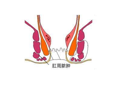 大理肛泰肛肠医院：所有的肛周脓肿必须手术么?