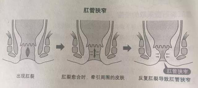 大理肛泰肛肠医院：患有肛裂，如何调理？