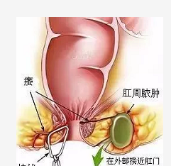 大理肛泰肛肠医院：肛瘘的症状有哪些/