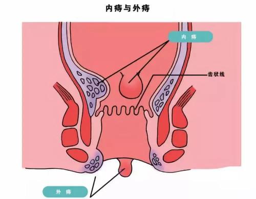大理肛泰肛肠医院：发现痔疮越长越多，这到底是咋回事？