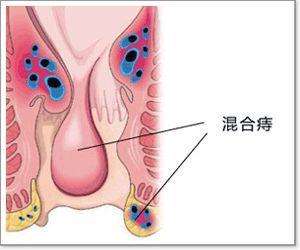 大理肛泰肛肠医院：混合痔病情到底有多复杂？