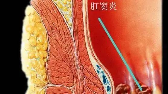 大理肛泰肛肠医院：肛肠疾病不容忽视的肛窦炎！