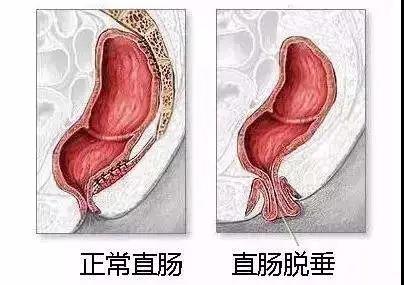 大理肛泰肛肠医院：脱肛是个很角色！那脱肛可以自行恢复吗？